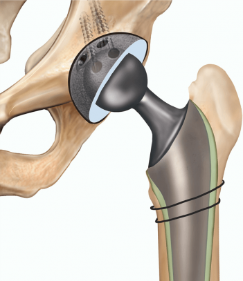 Hip Replacement