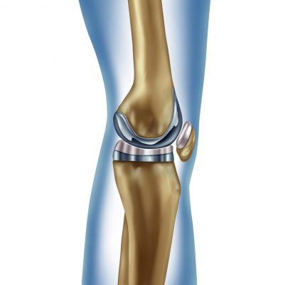 knee Replacement