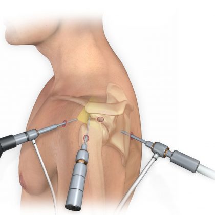 Shoulder Arthroscopy